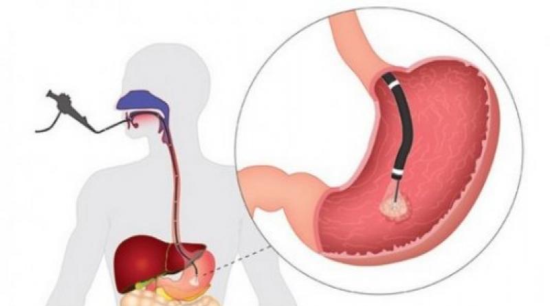 Подготовка к гастроскопии желудка Процедура гастроскопия желудка подготовка к обследованию
